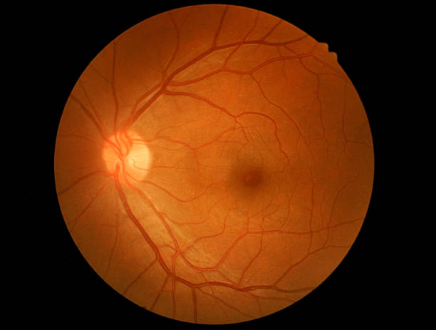 Effective Treatment Options for Retinal Holes a... main image