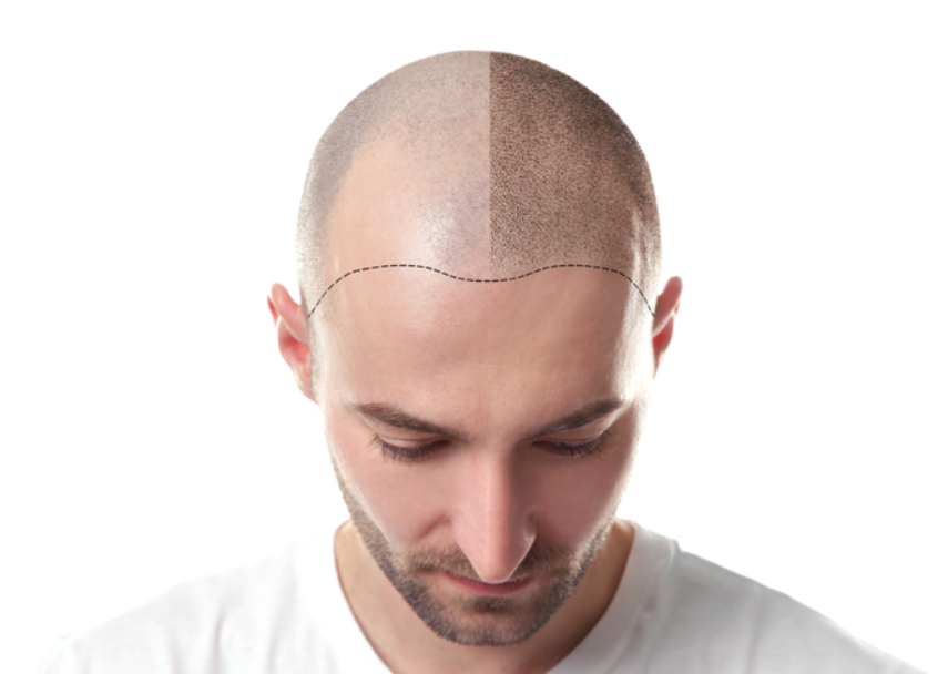 Discover the Secrets of Natural-Looking Hair Tr... main image