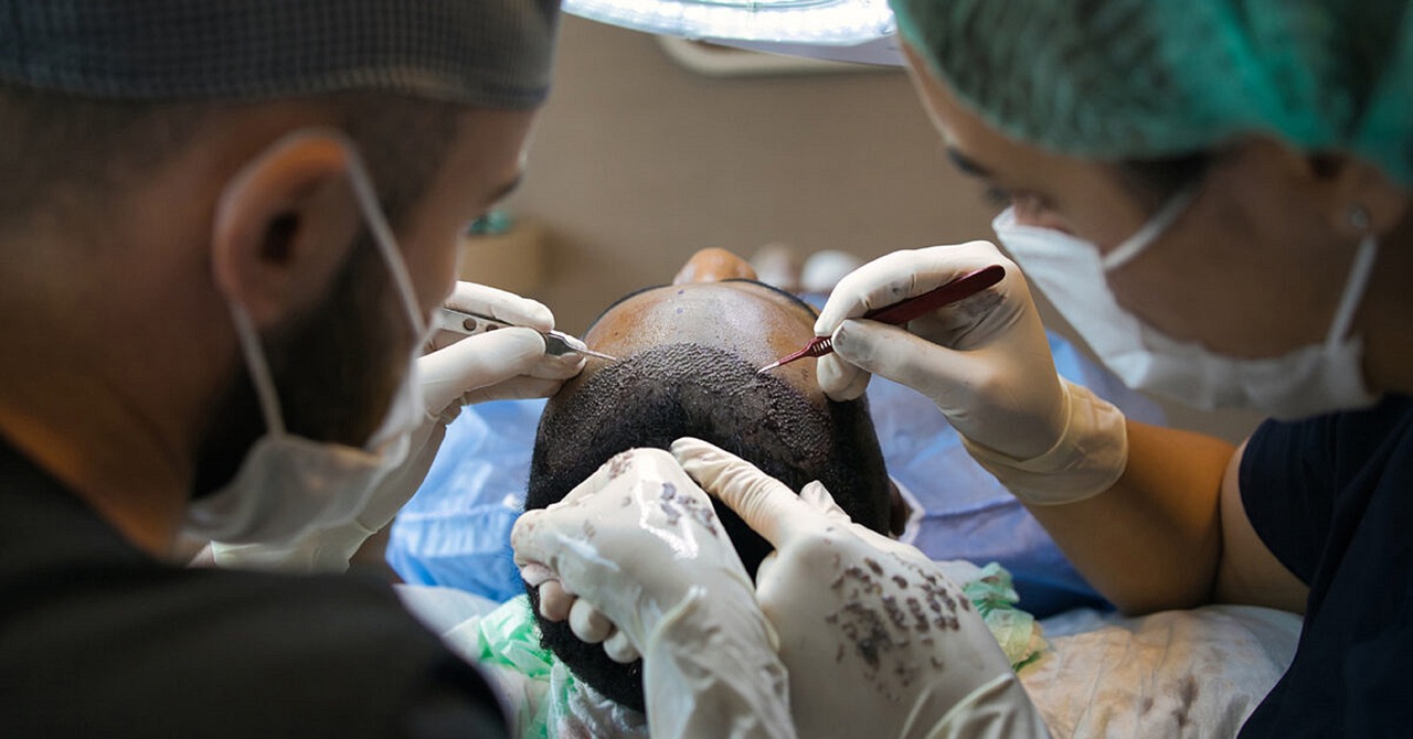 A receding hairline transplant, also known as a... main image
