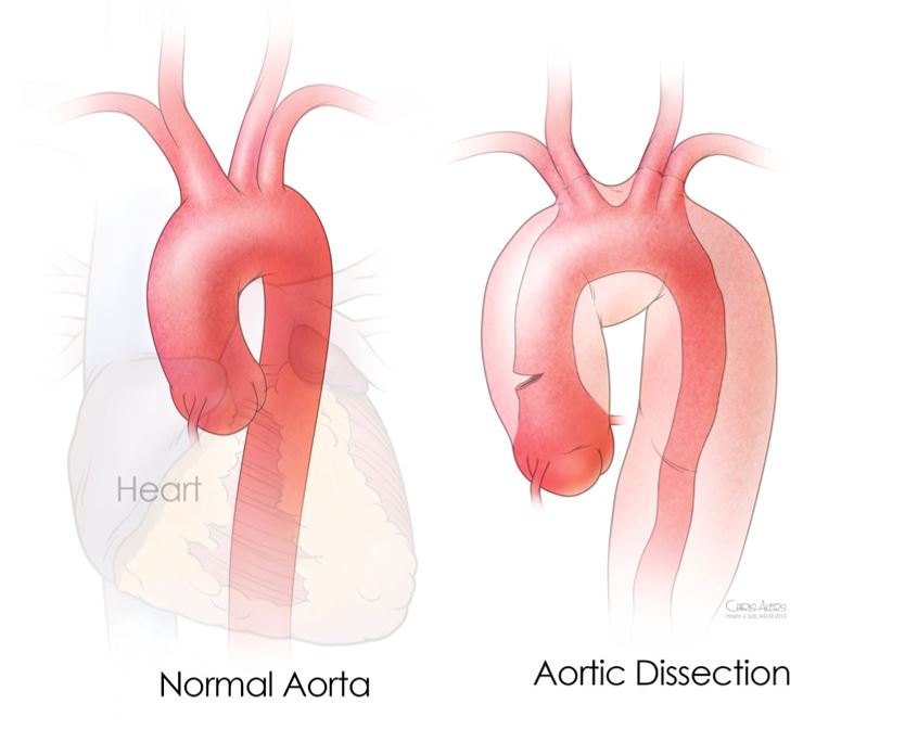 Aortic diseases occur due to various factors, i... main image