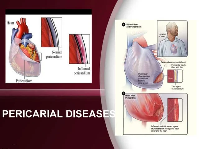
Pericardial diseases occur due to inflammation... main image