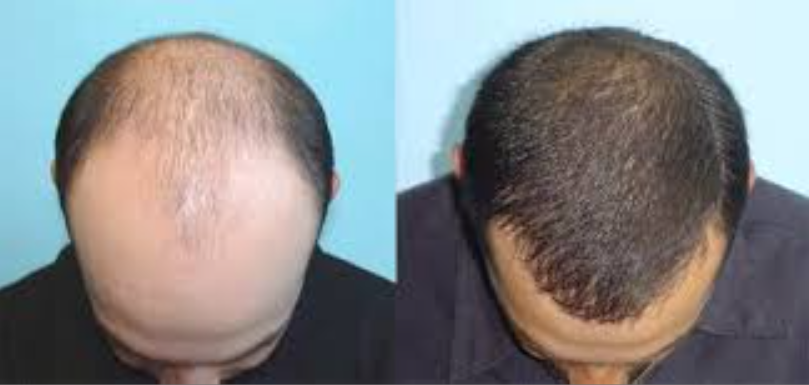 A Closer Look at FUE Hair Transplant: The Futur... main image