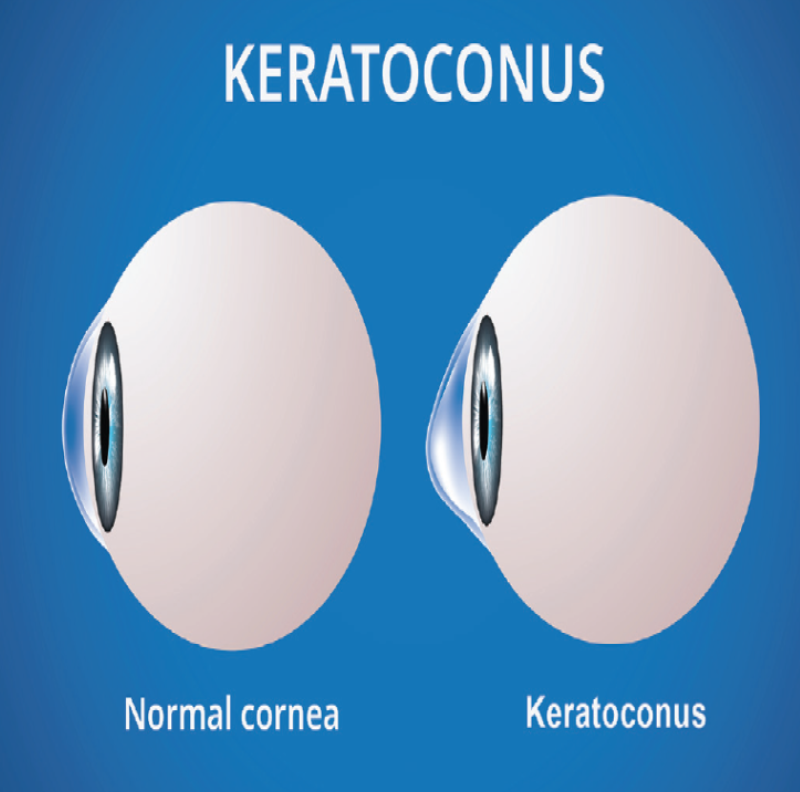 Combatting Keratoconus: Specialized Treatment at G... main image