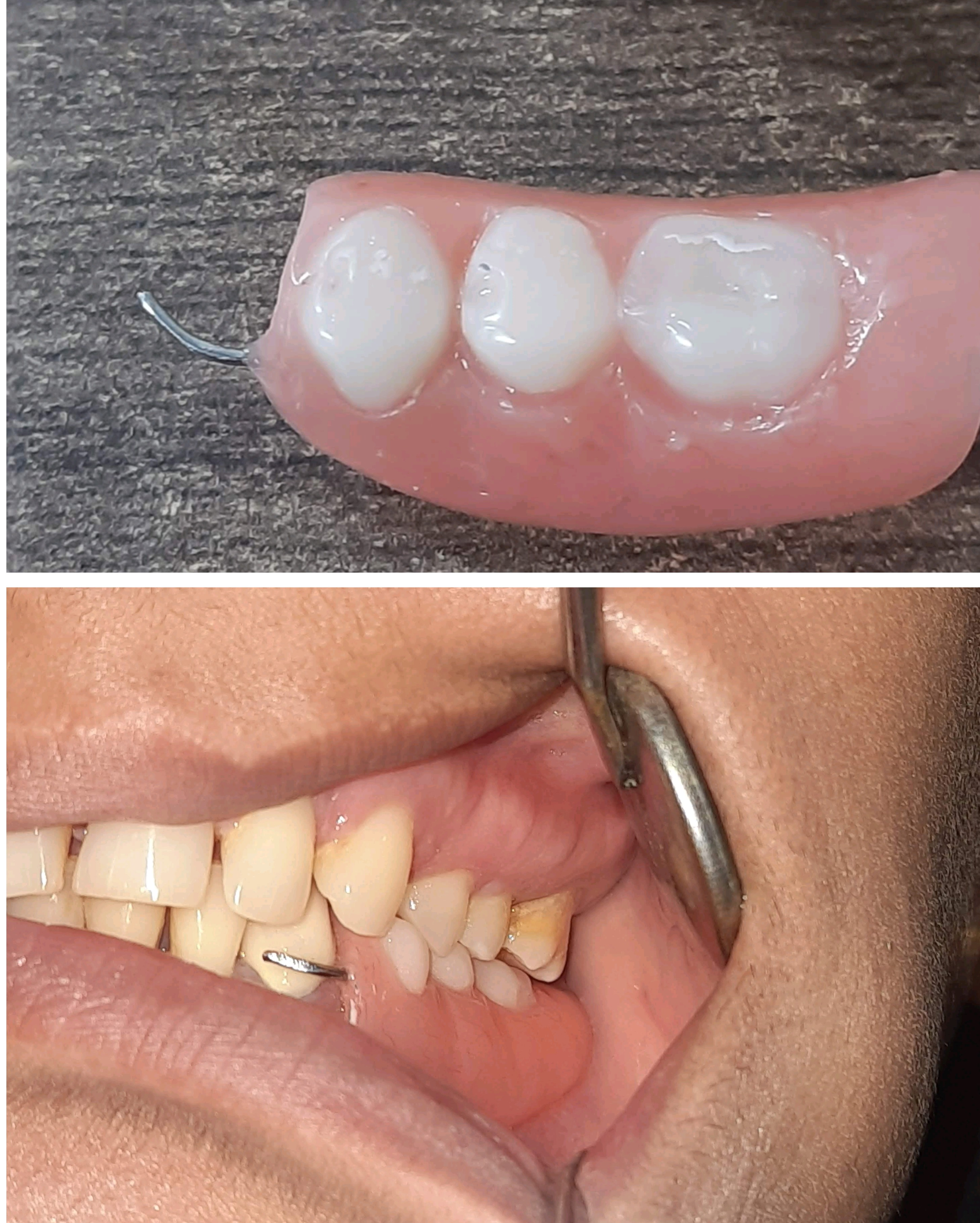 removable partial denture for replacing only th... main image