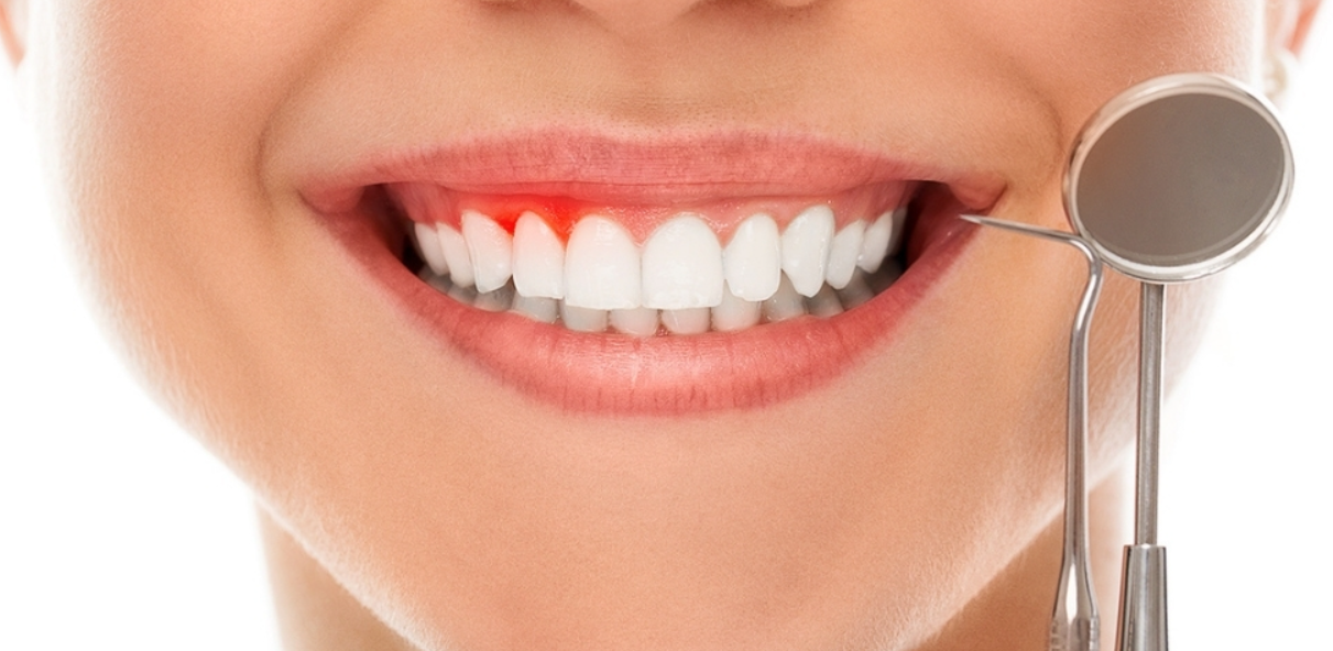 Combat Dental Gum Issues with Expert Treatment at ... main image