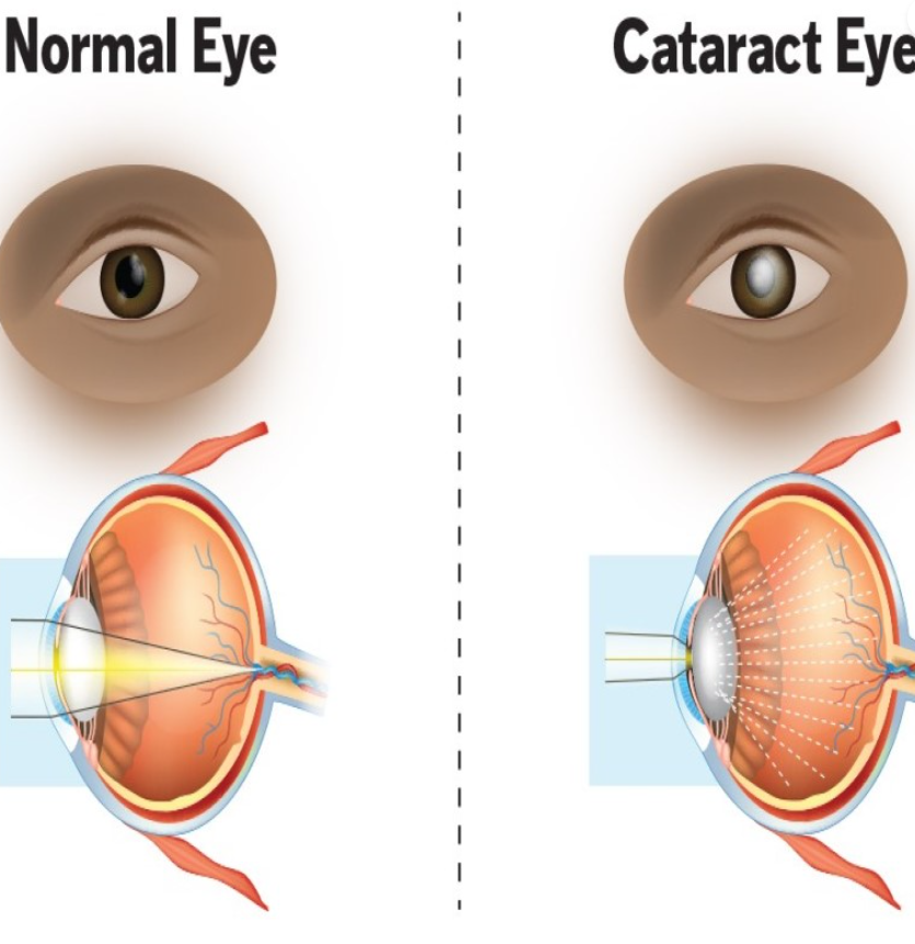 Clear Vision Awaits: Expert Cataract Treatment ... main image
