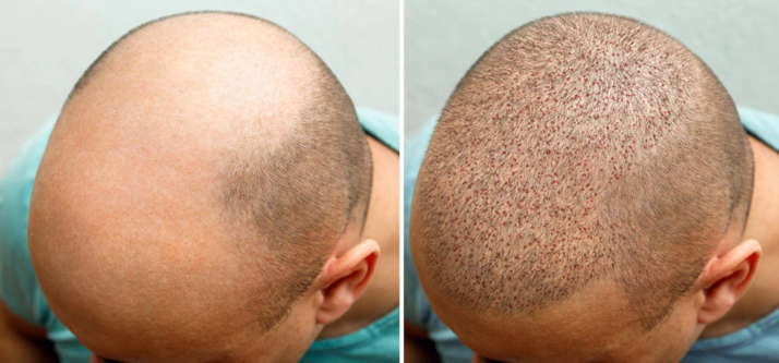 Top Hair Transplant in Chennai: Eloraa Cliniq D... main image