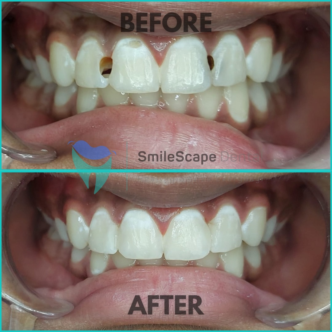 Teeth decay or cavities happen due to gradual b... main image