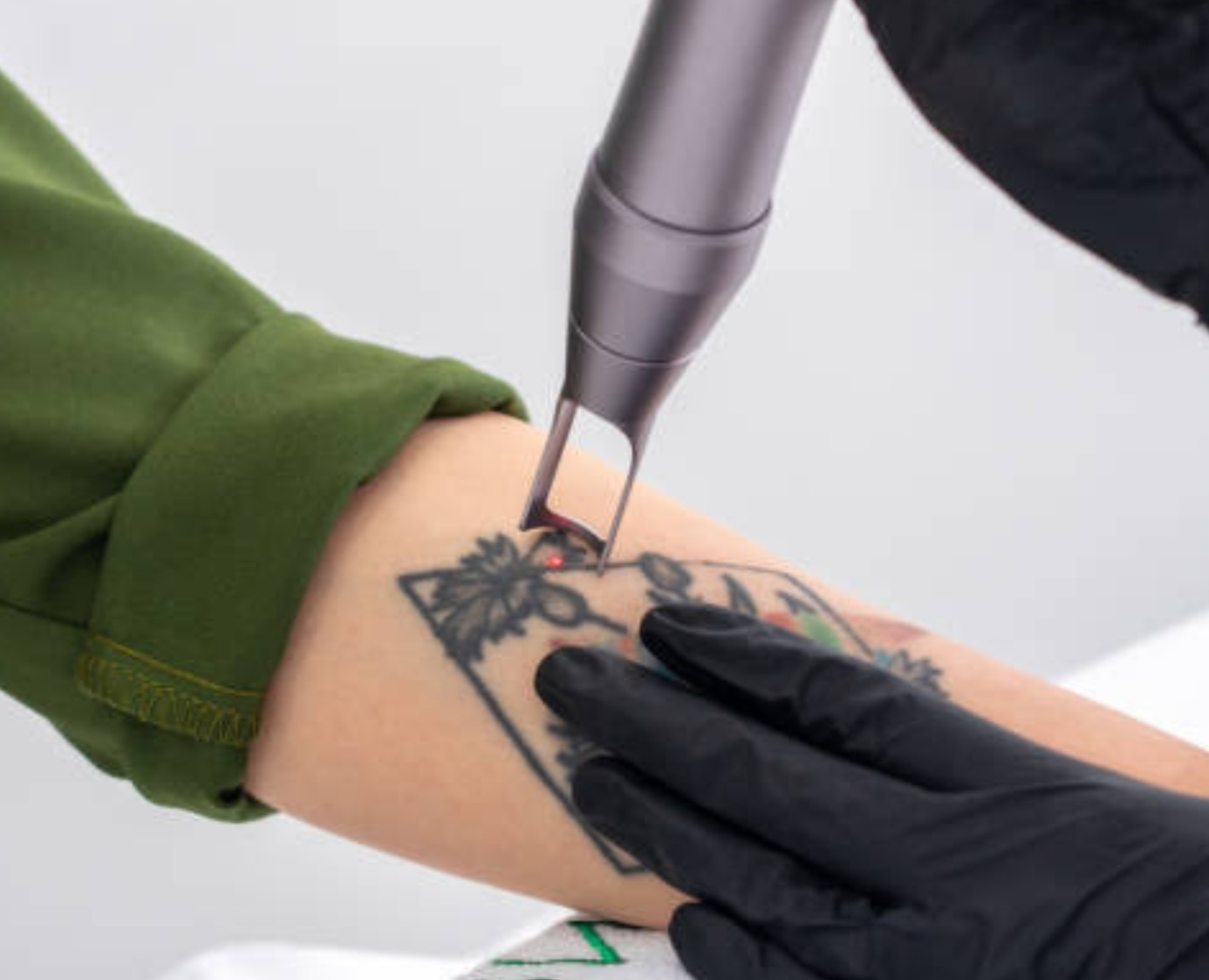 Tattoos used to be considered permanent, but th... main image
