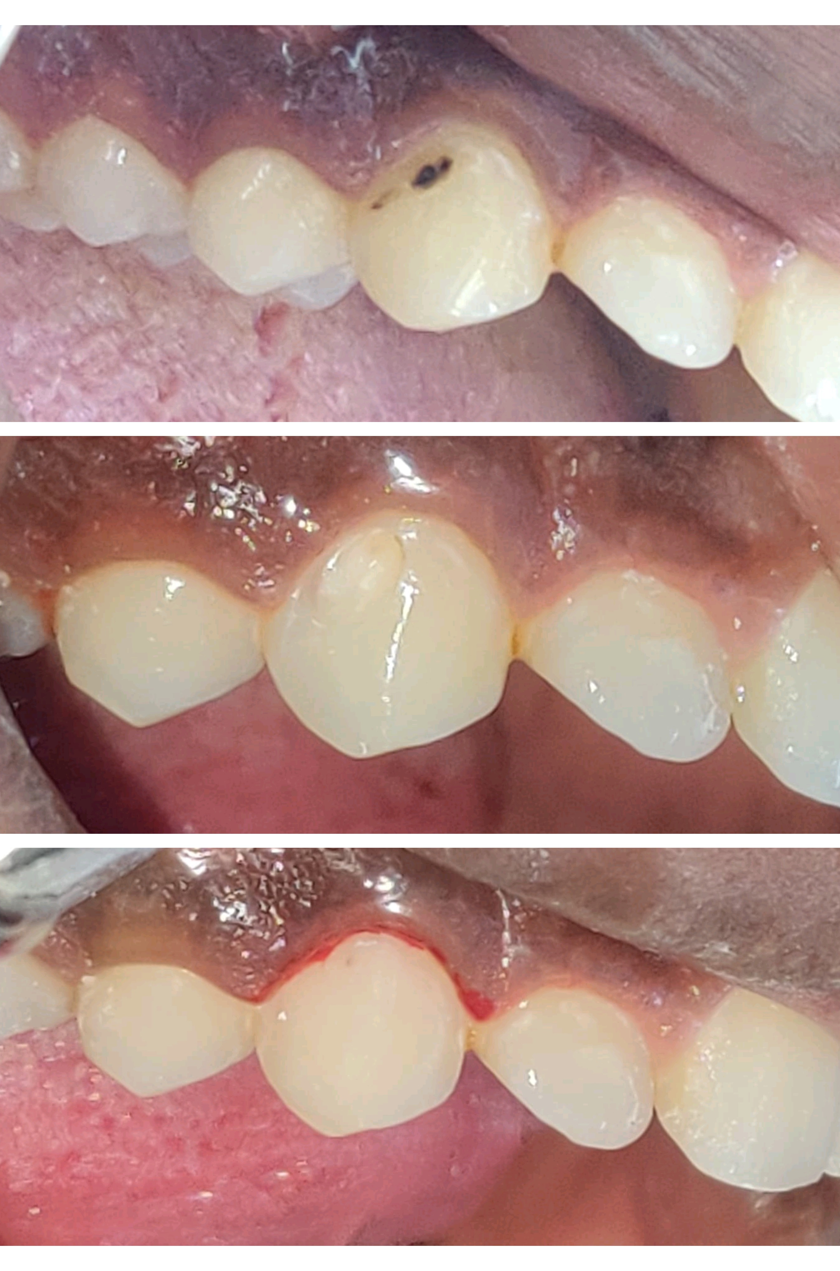 tooth coloured restoration of tooth 
#cosmeticd... main image
