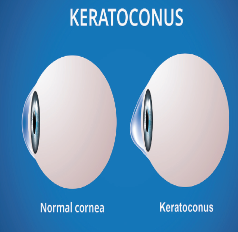 Revolutionizing Keratoconus Treatment: Green City ... main image