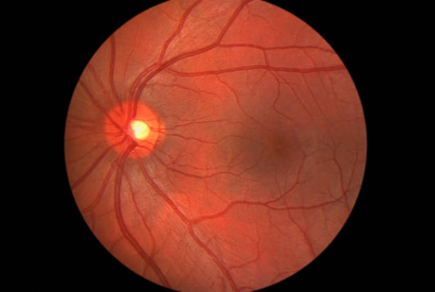 Discover Advanced Detached Retina Treatment at ... main image