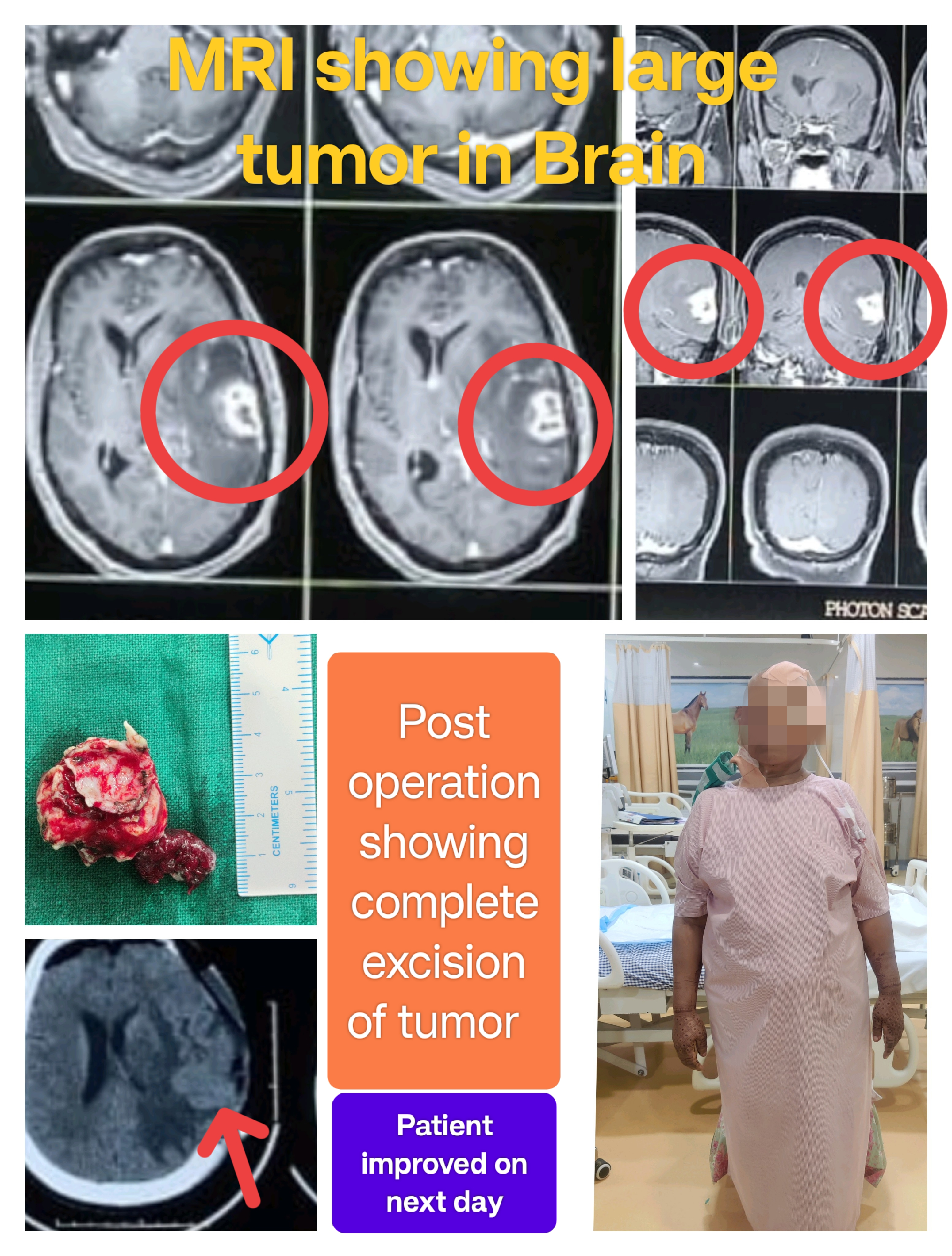40 वर्ष की महिला जिनके सीर में बहुत बड़ी कैंसर की ... main image