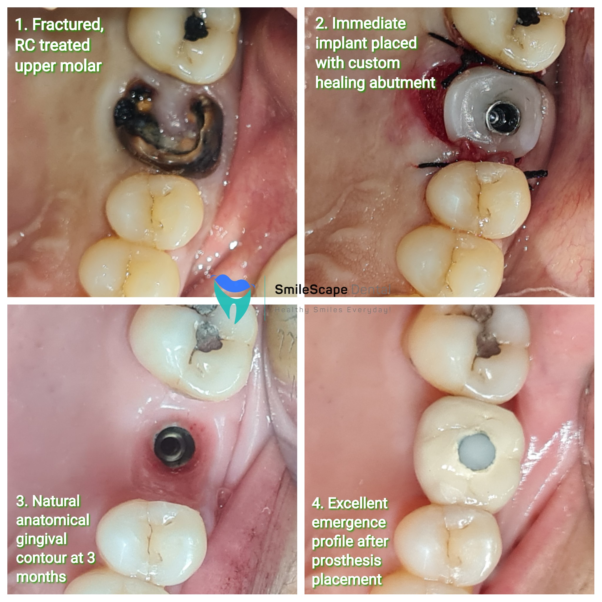 Fractured tooth or teeth pose problems in chewi... main image
