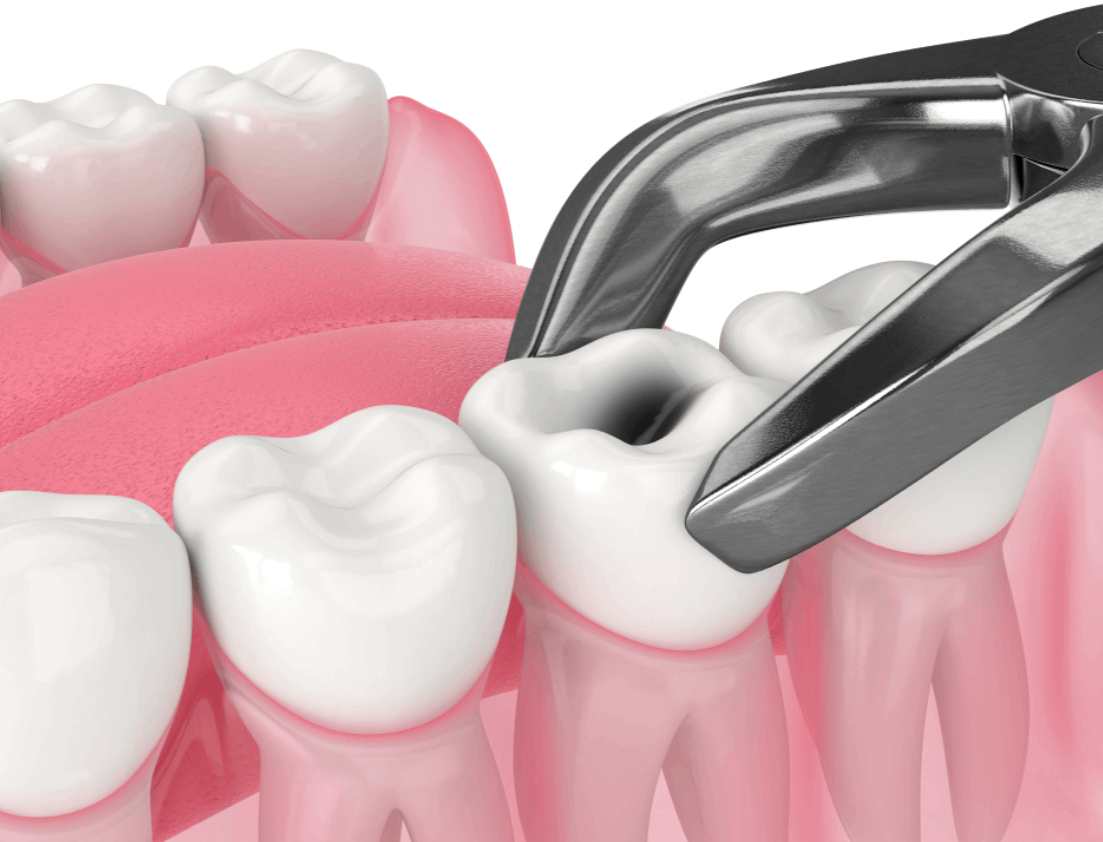 Expert Dental Extractions at Dr. Rai's Dental Aven... main image