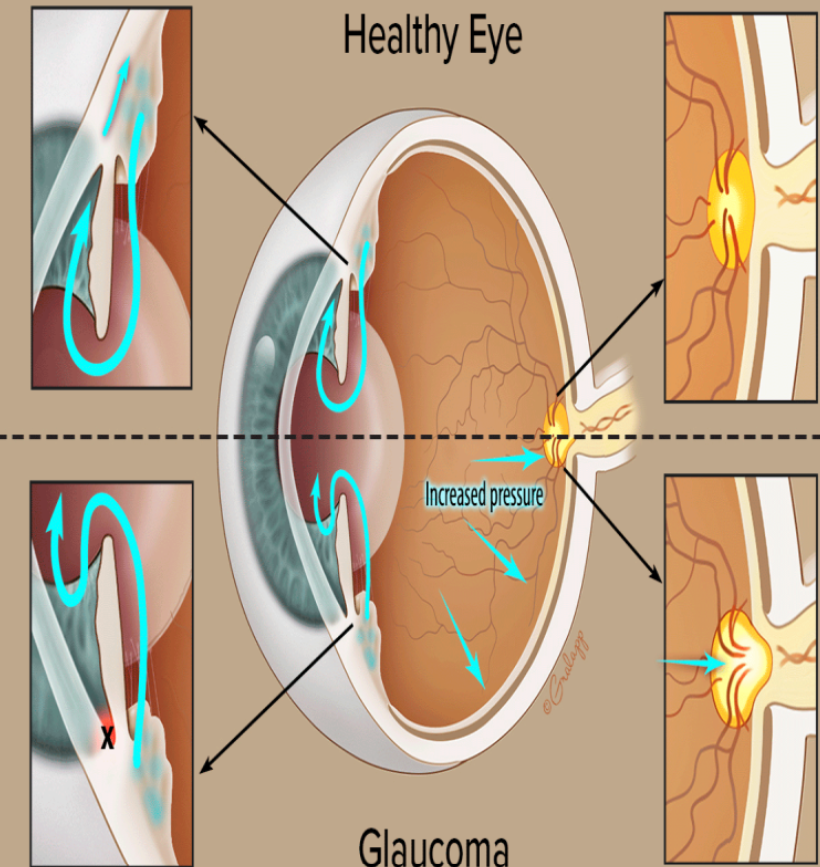 Combatting Glaucoma: Green City Eye Clinic's Pr... main image