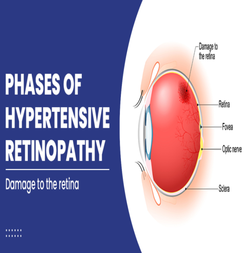 Addressing Hypertensive Retinopathy: Green City... main image