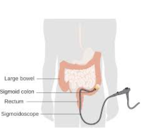 Understanding Sigmoidoscopy: Your Key to Digest... main image
