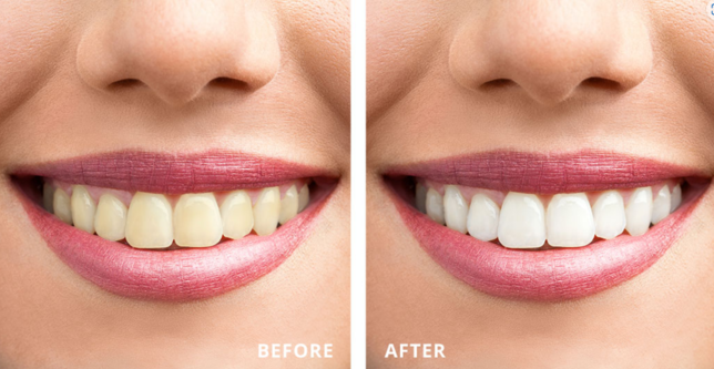 Achieve a Brighter Smile with Teeth Whitening Trea... main image