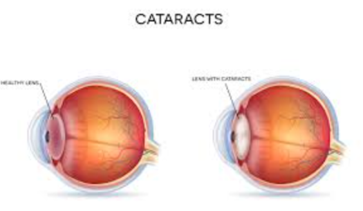 Cataract Care Excellence: Green City Eye Clinic... main image