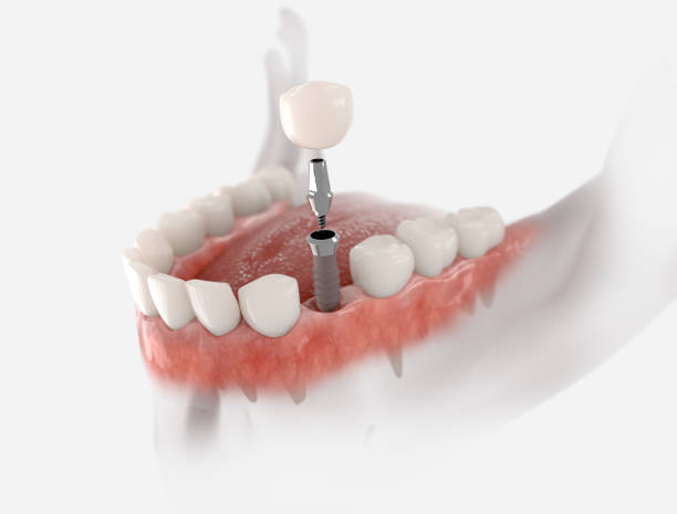 Transforming Lives: Finding the Best Dental Imp... main image