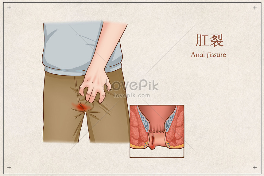 Anal Fissure-
Anal Fissure is a linear tear ove... main image