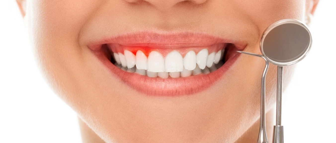 Combat Gum Disease with Dental Gum Treatment at Dr... main image