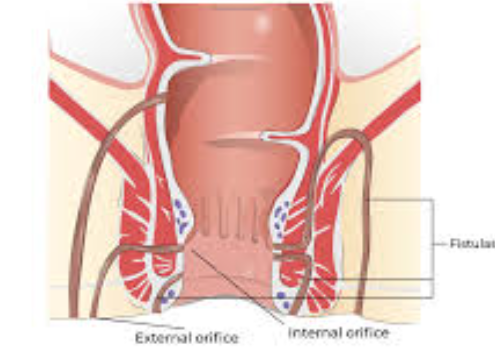 Managing Fistula: Comprehensive Care at Dr. Pha... main image