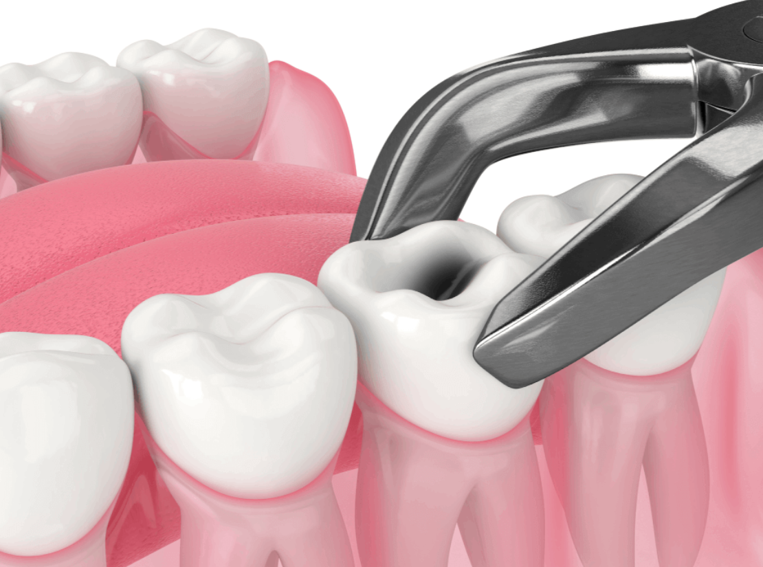 Expert Dental Extractions at Dr. Rai's Dental Aven... main image