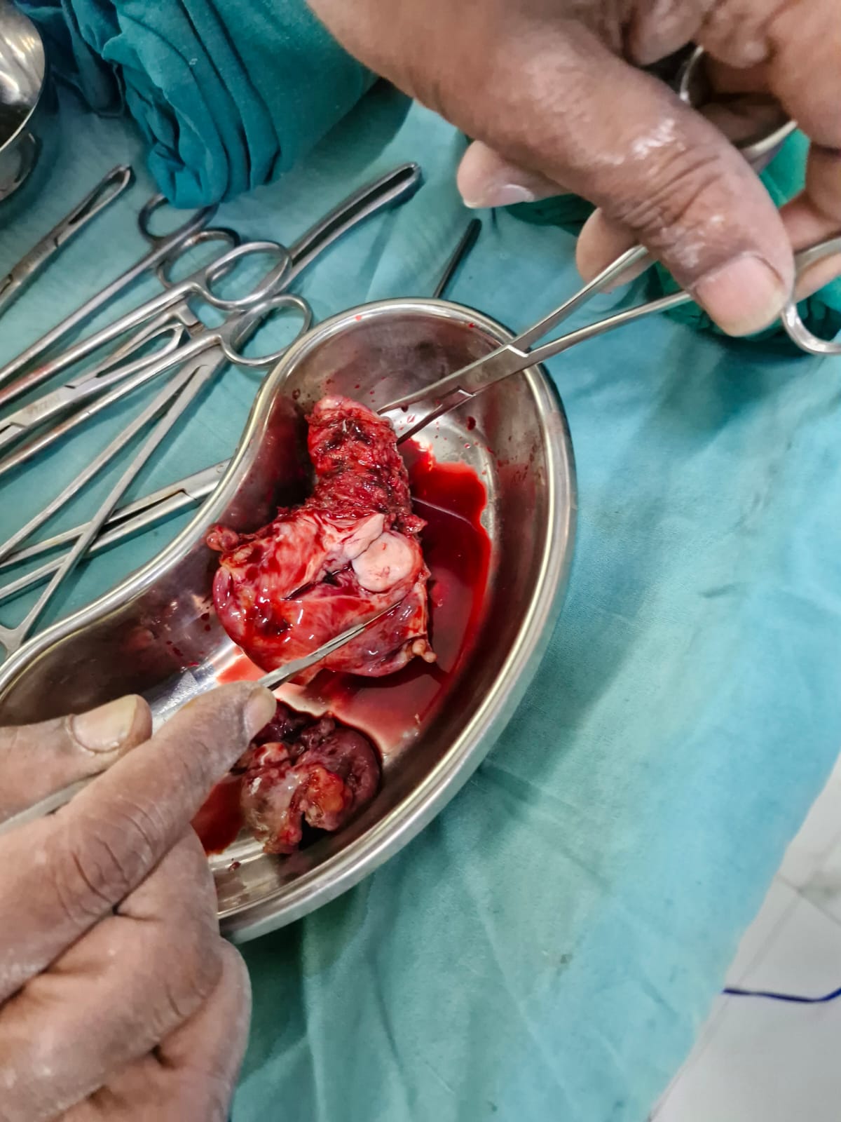 Total Laparoscopic Hysterectomy with bil. oopherec... main image
