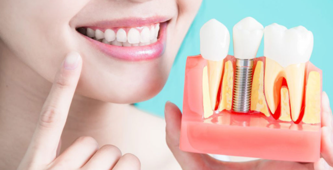 Restore Your Smile with Dental Implant Surgery at ... main image