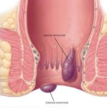 Precision Healing: Laser Piles Operation at Dr.... main image