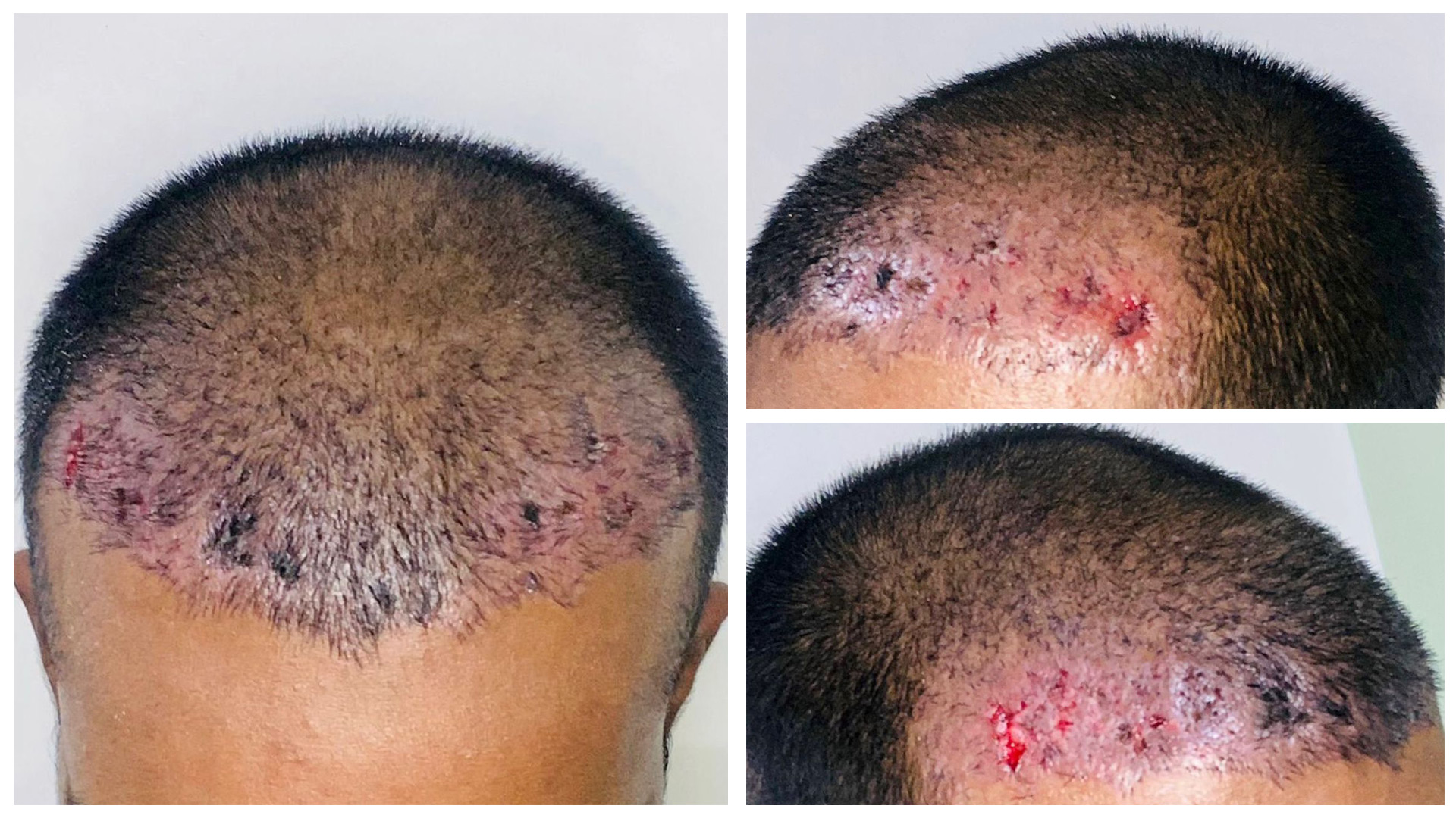 !!! WARNING !!! Always choose your Hair Transpl... main image