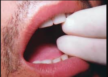 Regain Your Smile: Treatment for Reduced Mouth ... main image