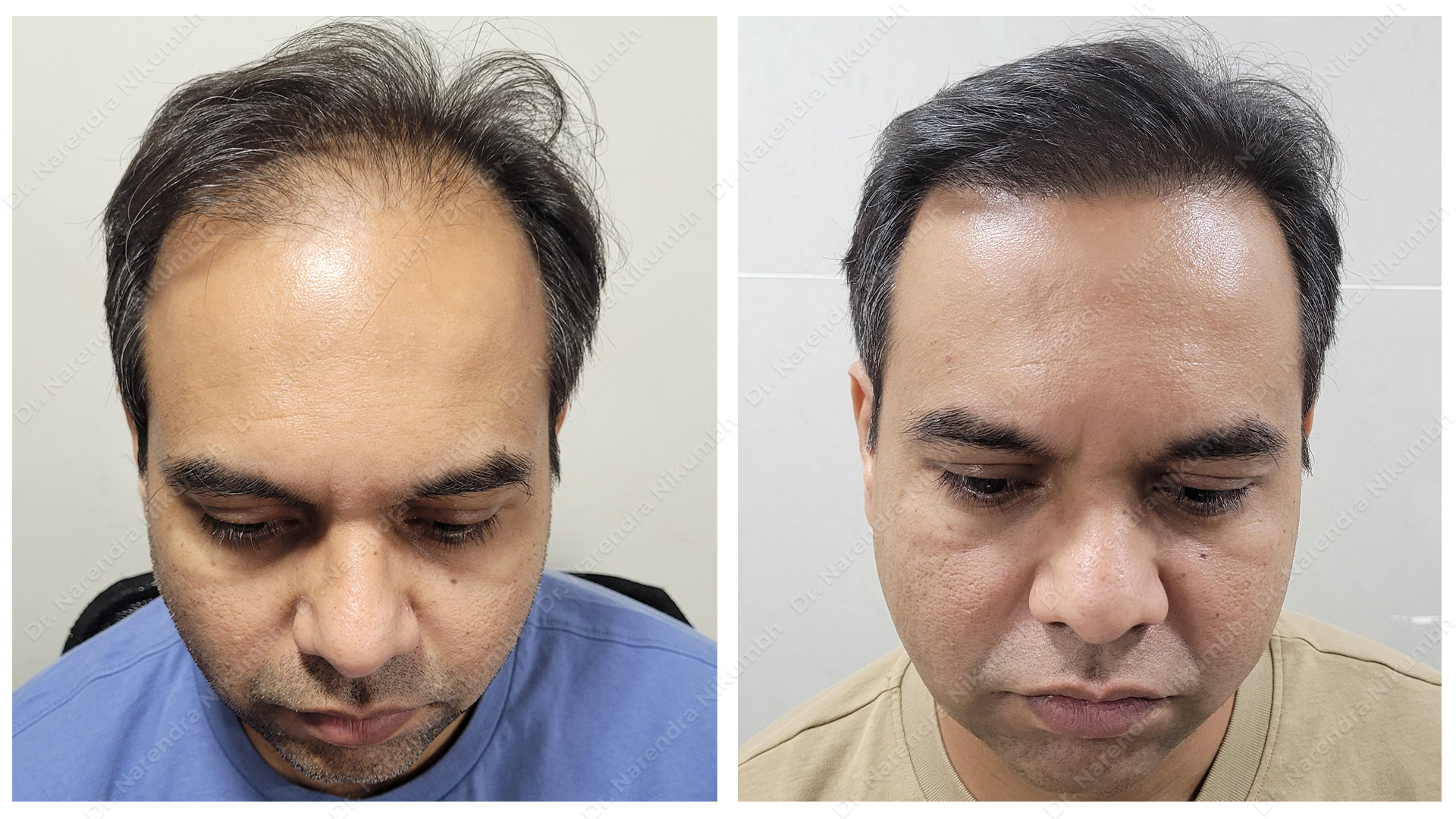 Best Hair Transplant Clinic in Thane - Dr Naren... main image
