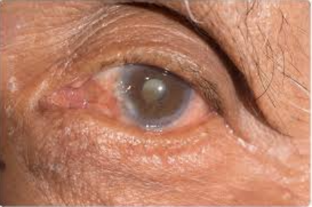 Regain Clarity: Comprehensive Cataract Treatmen... main image