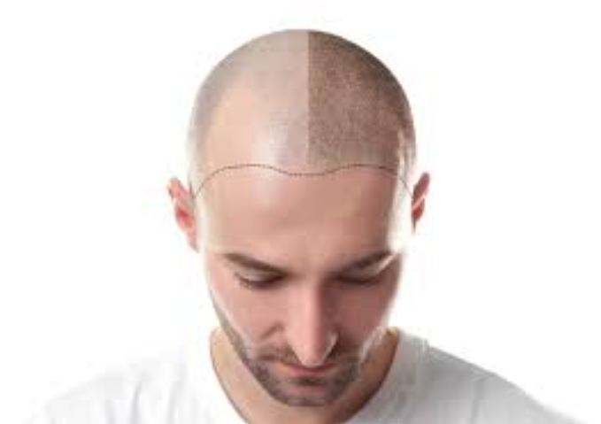 Experience FUE Hair Transplant at ELORAA CLINIQ... main image