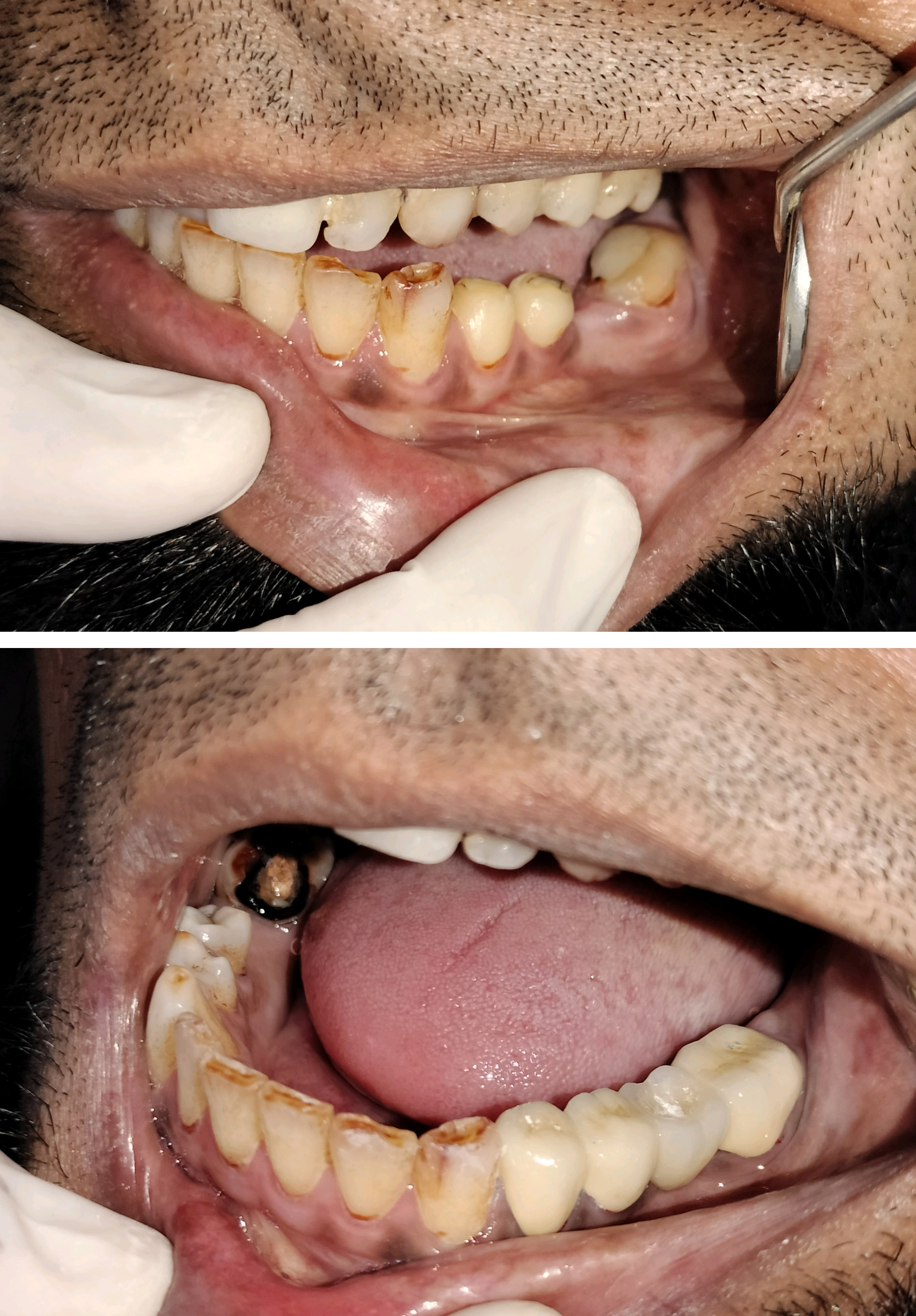 replace your missing tooth with tooth coloured ... main image
