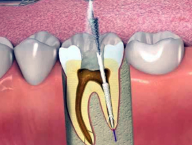 Painless RCT at Dr. Rai's Dental Avenue in Thane E... main image