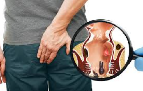 Nourish Your Way to Recovery: Piles Diet Tips f... main image