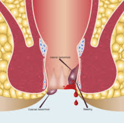 Say Goodbye to Piles Pain: Laser Piles Treatmen... main image