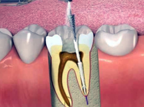 Effective Root Canal Treatment at Dr. Rai's Dental... main image