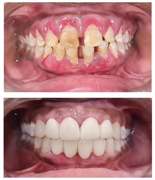 Smile Makeover or rehabilitation comprises of a... main image