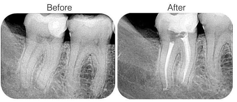 Best Root Canal Treatment in Jaipur - Dr. Vaibh... main image