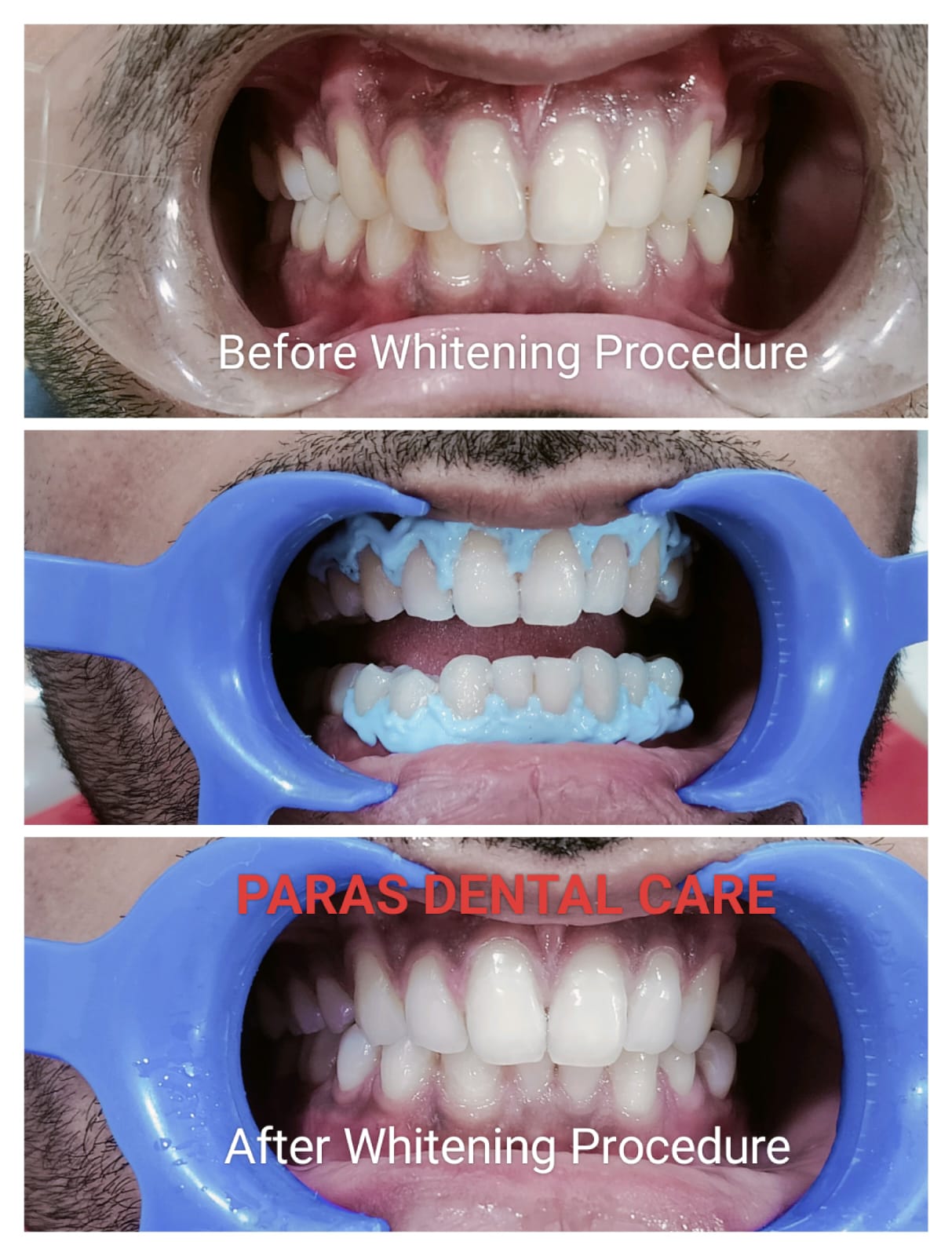 Best Teeth Whitening Clinic in Jaipur - Dr. Vaibha... main image