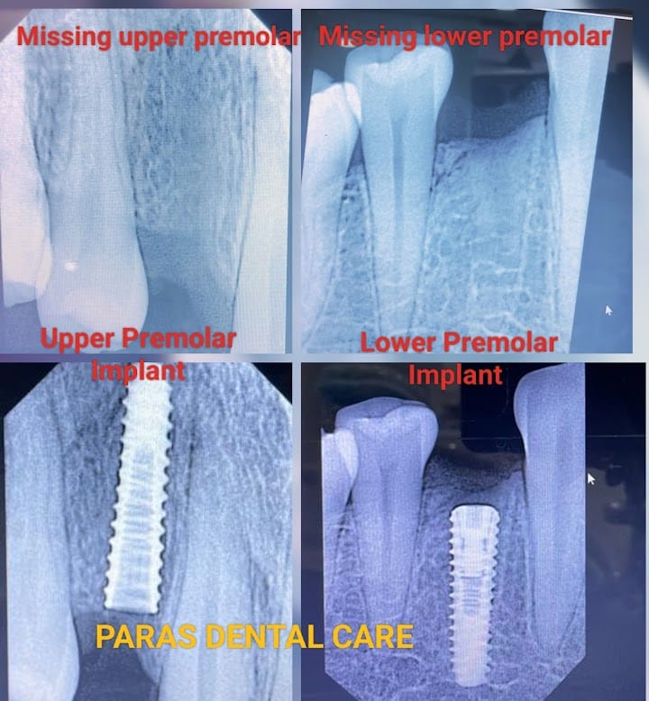 Best Dental Implants Clinic in Jaipur - Dr. Alp... main image