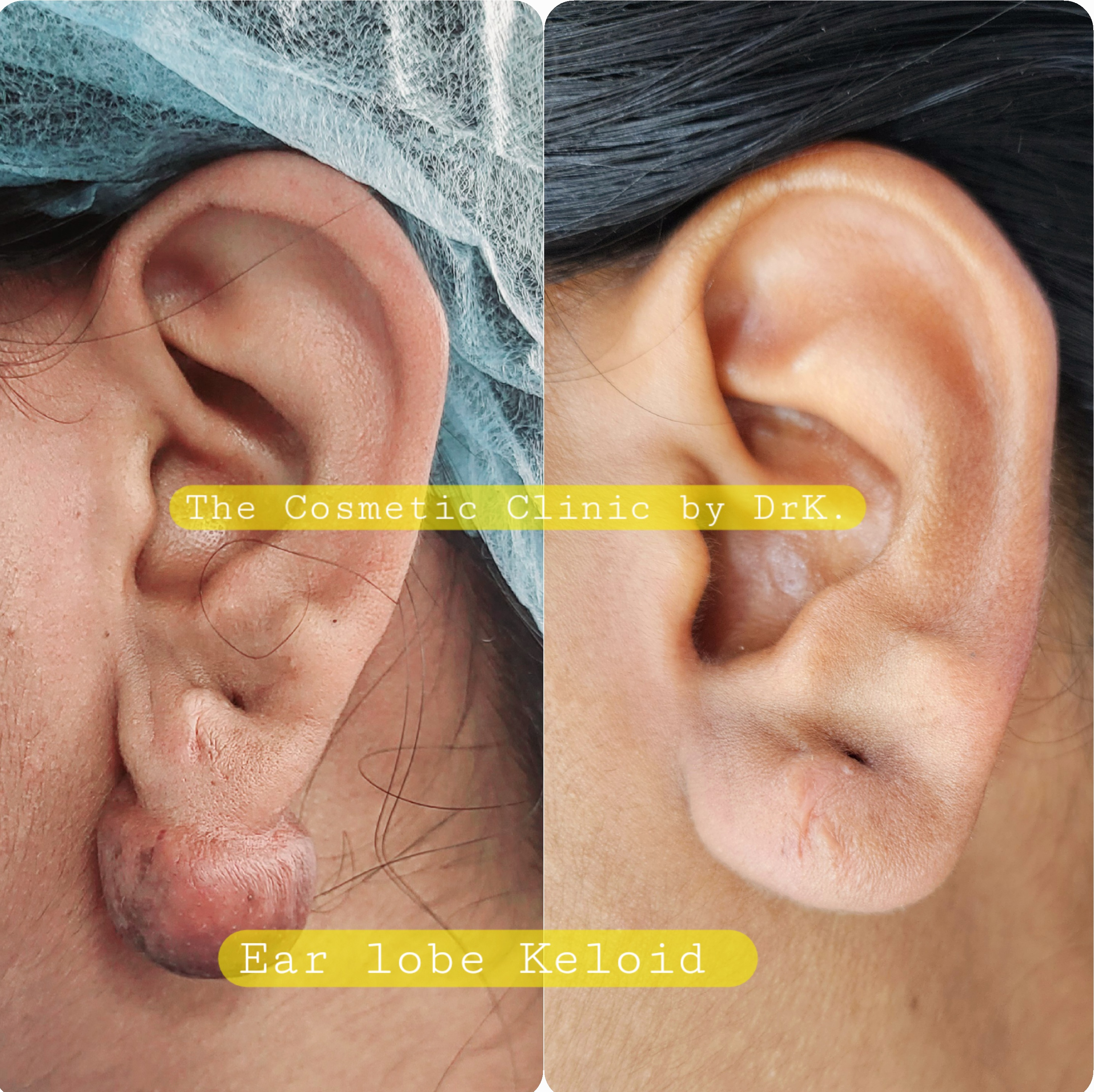 Ear lobe keloid 
A keloid on your ear is a type... main image