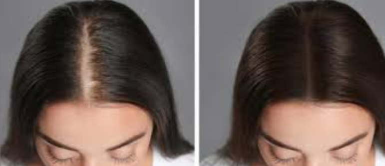 Hair Implant for Women at ELORAA CLINIQ Special... main image