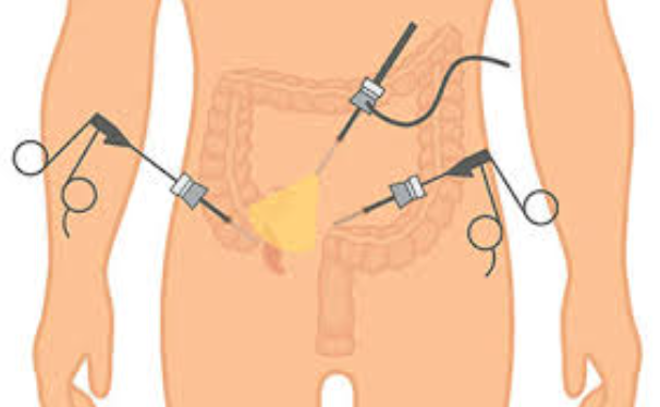 Laparoscopic Procedures for Appendicitis: Minimizi... main image