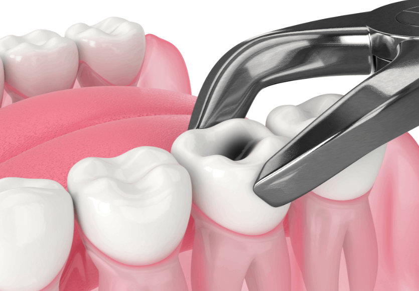 Safe and Gentle Tooth Extraction Procedure at Dr. ... main image